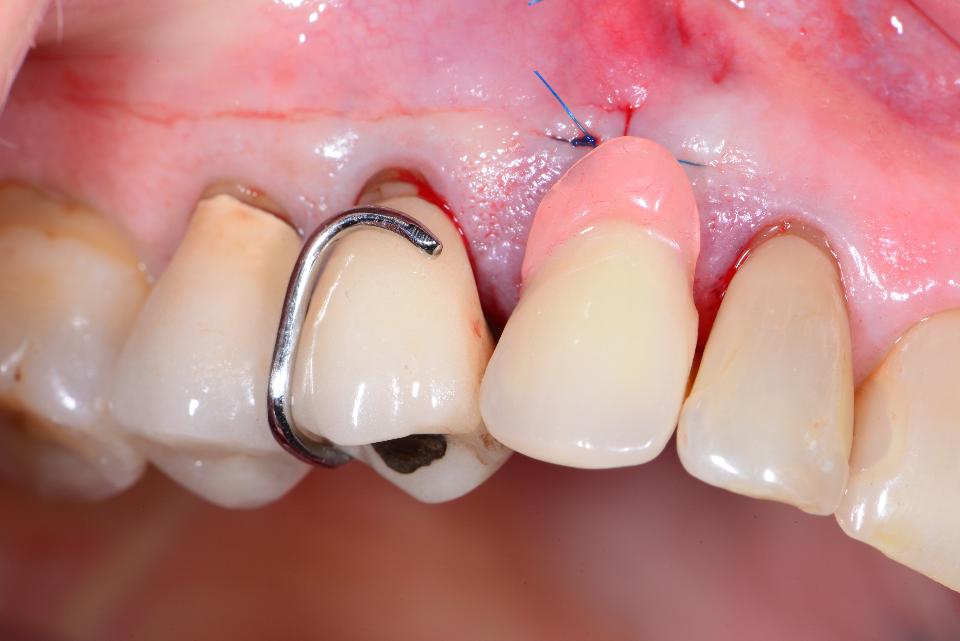 Fig. 9: A prepared provisional and removable partial denture are then applied