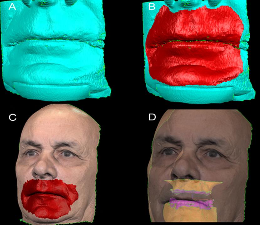 Fig. 11: Matching process between a CBCT scan and a facial scan. Starting from the soft tissue reconstruction from a CBCT (A), a region of interest is selected (red patch in B) and a corresponding region of interest is selected on the 3D surface scan (red patch in C) leading to acceptable registration results (D)