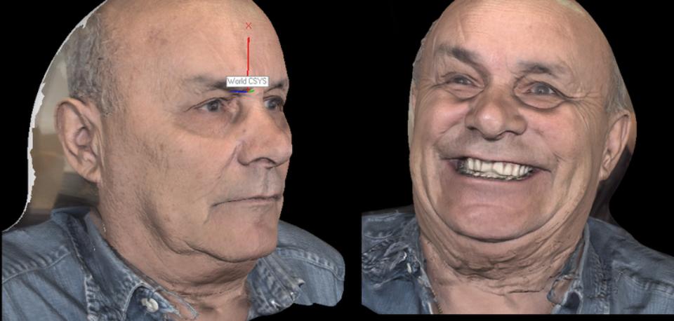 Fig. 6: Pritidenta 3D® (pritidenta® GmbH, Leinfelden, Germany) facial scan of the patient (same as Figs 4 & 5) in neutral and smiling positions