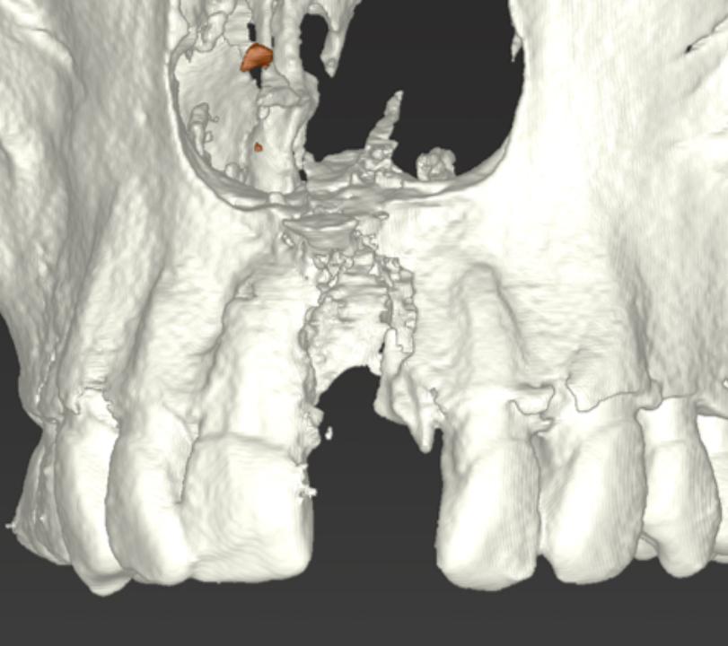 Fig. 39: Extended resorption after implant loss with irregular anatomy requires modified block technique in terms of shell technique