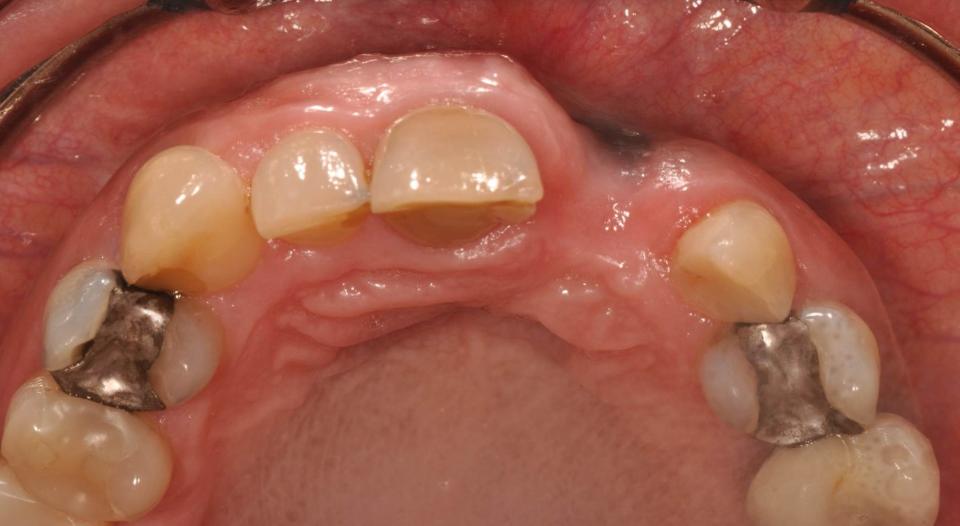 Fig. 2: Severe bone loss due to the total loss of the buccal bundle bone caused by infection (root fracture)