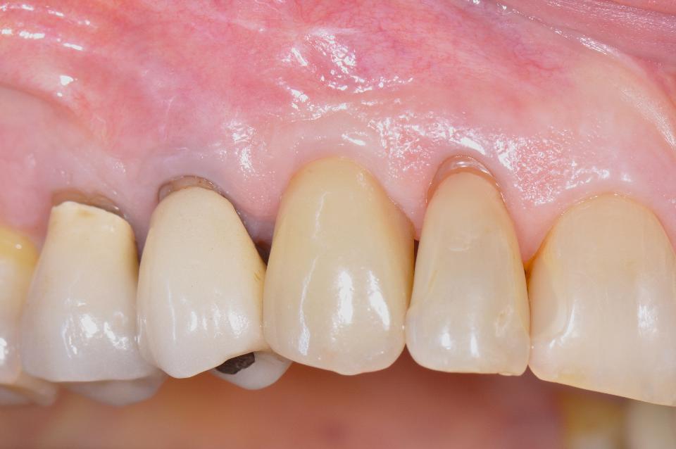 Fig. 25: The 3-year follow-up examination shows stable peri-implant soft tissues. The patient has excellent home care resulting in healthy peri-implant mucosa free of inflammation
