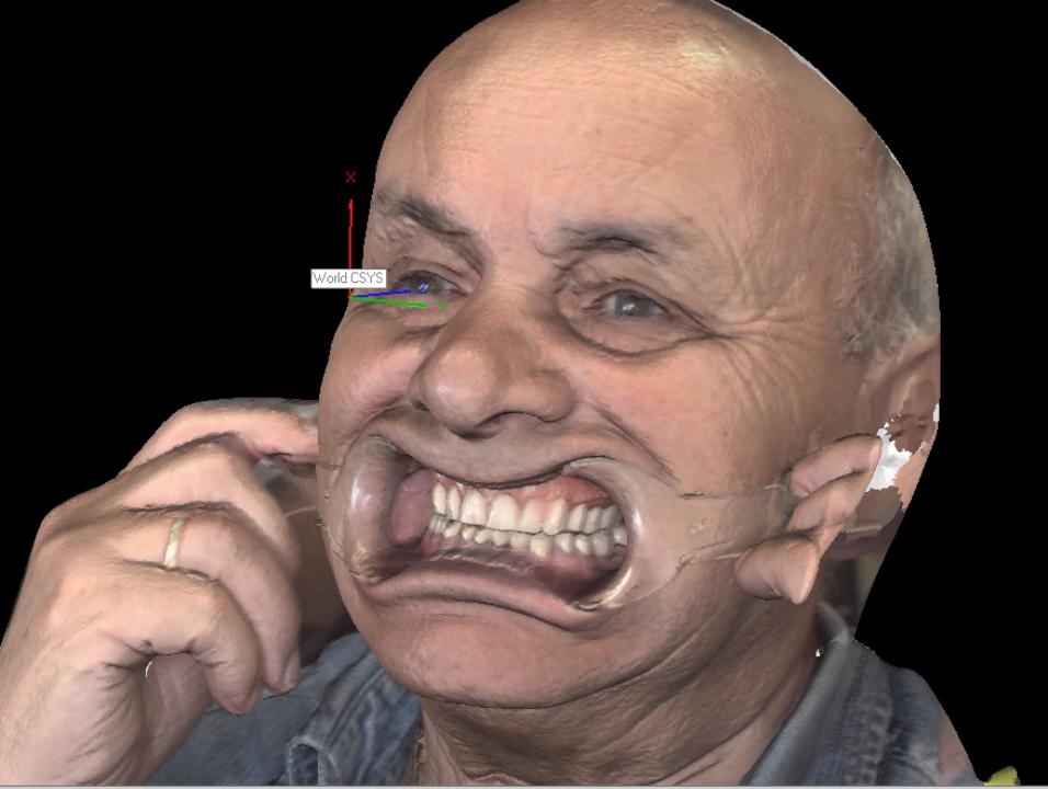 Fig. 10: Pritidenta® facial scan of the patient with upper interim denture. The acrylic teeth pose no challenge to the scanner