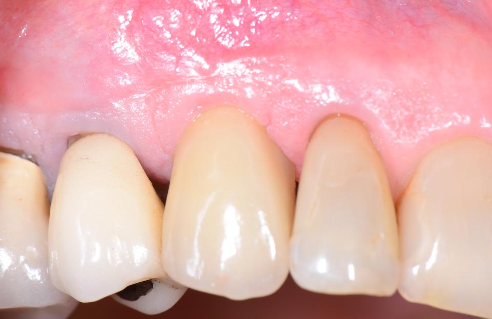 Fig. 24: Clinical status 6 months following implant placement. The implant crown was fabricated by the referring dentist. The mucosal margin is convex, correctly positioned and shows no visible signs of inflammation