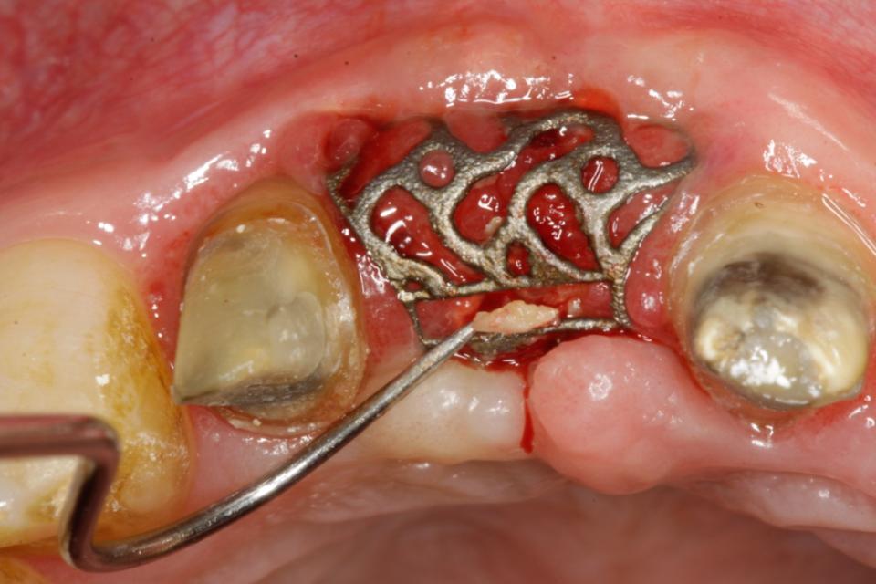 Fig. 43: Severe dehiscence of a 3D-printed titanium mesh (alio loco) as a complication associated with this technology