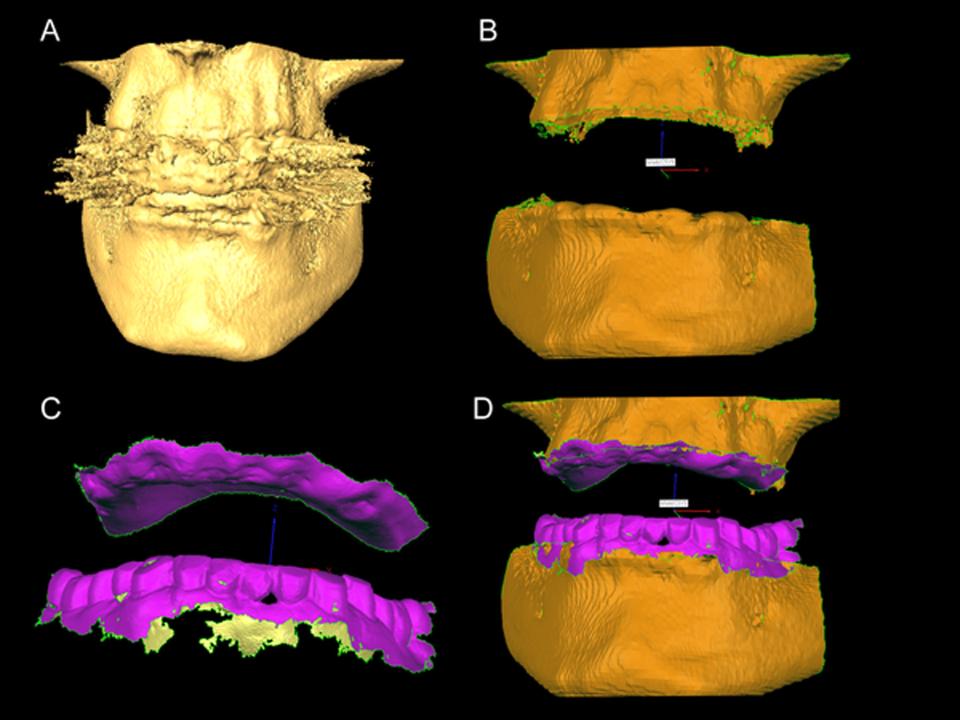 Fig. 7: The original CBCT scan of a medium field of view (8x8 cm) (A). Notice the excessive streak artifacts resulting from the metal-porcelain bridge. The teeth were then digitally removed (B) and the True Definition 3D (3M ESPE, St. Paul, MN) intraoral scan (C) was fitted to the CBCT scan in the anatomically correct position (D) 
