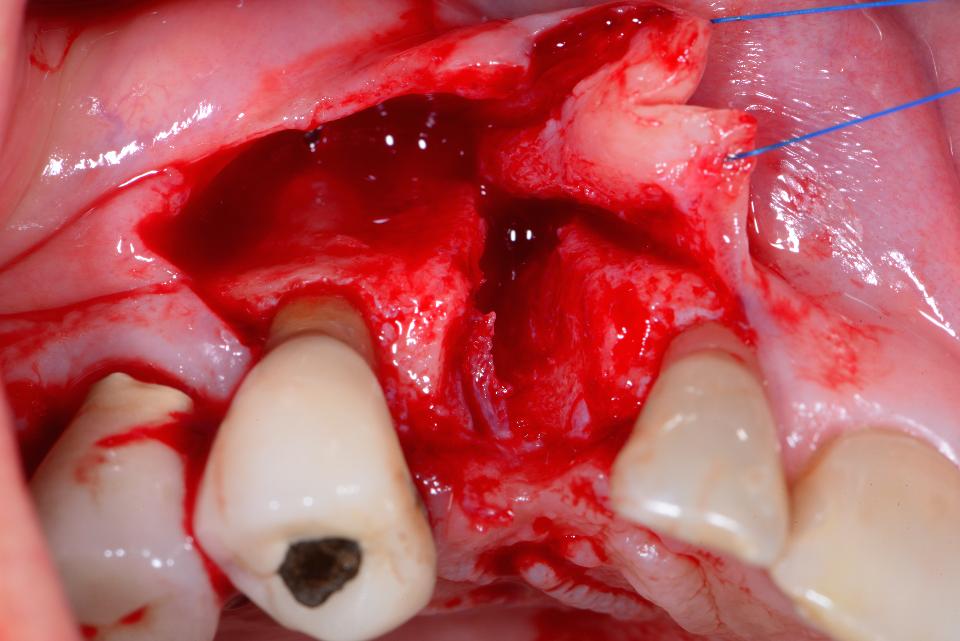Fig. 12: The triangular mucoperiosteal flap is elevated. The intrasurgical inspection shows the typical crater-like defect and exceptional thickness of the full-thickness flap in the area of the socket