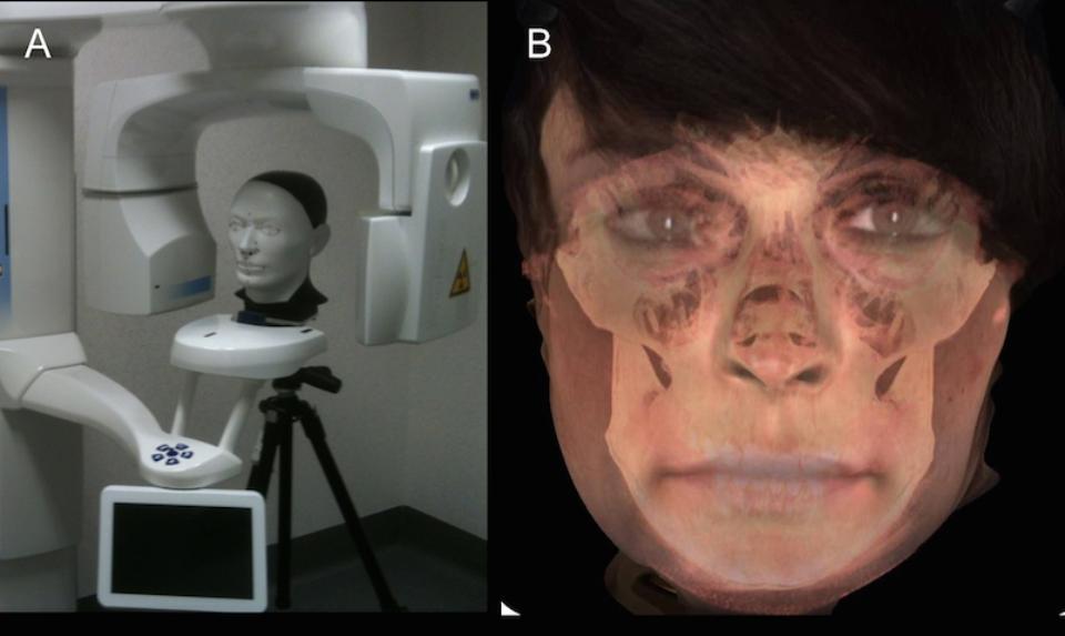 Fig. 3: An example of a CBCT machine with a built-in facial scanning system, allowing for integrated 3D clinical and radiographic imaging (Planmeca ProMax 3D combined with a ProFace, Planmeca, Helsinki, Finland; A) and the results of a combined integrated scanning allowing the underlying bony tissues to be visualized concomitantly with the soft tissues of the same subject (B)