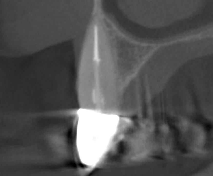 Fig. 5: The sagittal CBCT cut shows no evidence of a facial bone wall. Therefore, immediate implant placement is not an option according to our selection criteria