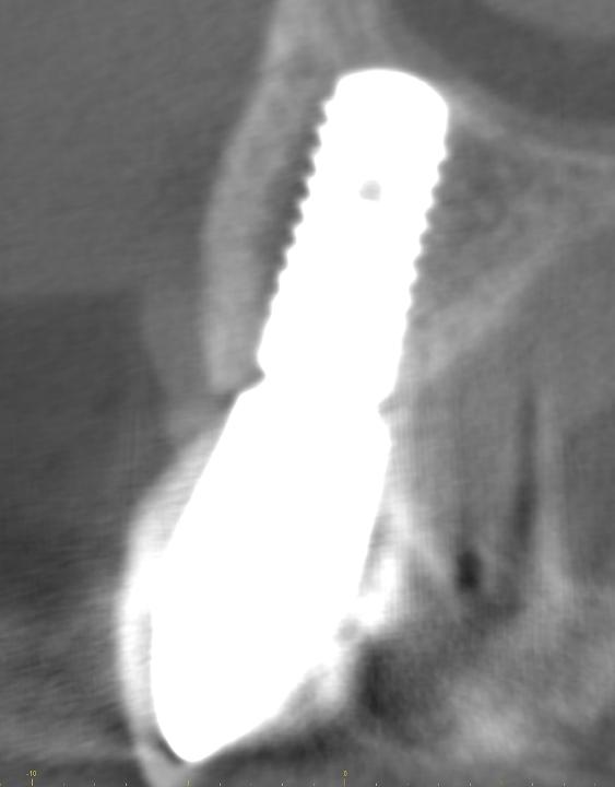 Fig 27: The horizontal CBCT cut confirms how well the facial bone wall has regenerated during healing. In addition, the implant is well positioned oro-facially, which is important for a successful outcome