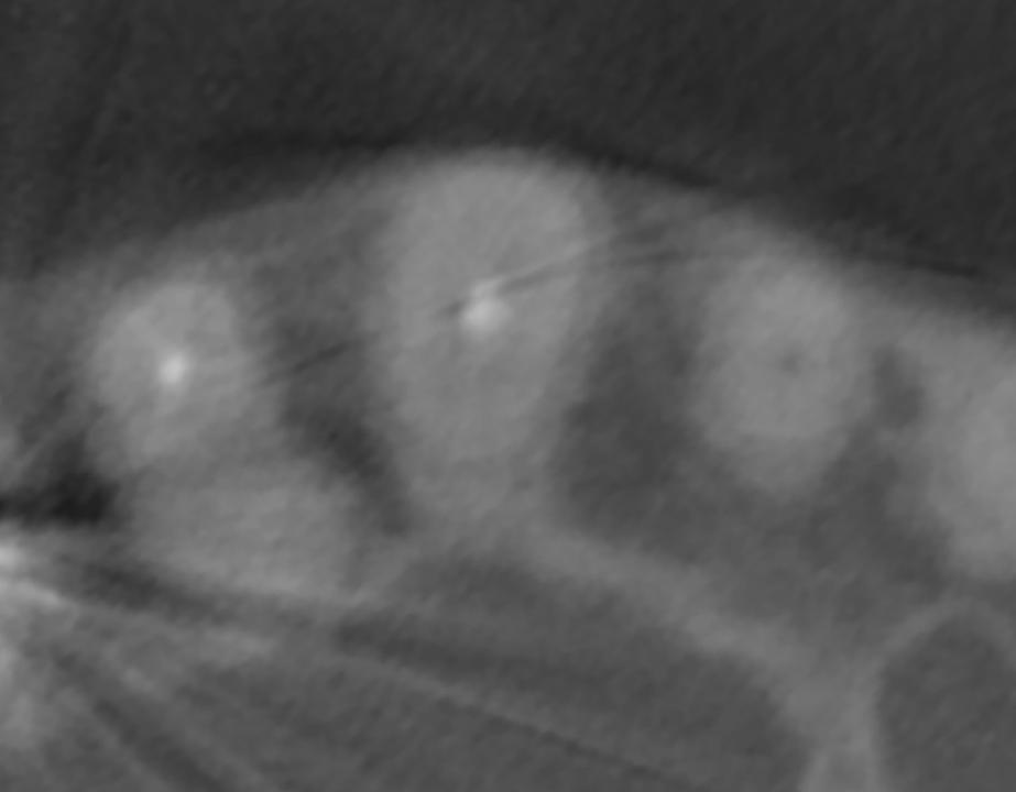 Fig. 6: The horizontal CBCT cut shows a sufficient crest width of more than 6 mm mesially and distally to the canine. Thus, a 2-wall defect will be present during implant surgery after 6 to 8 weeks of soft tissue healing