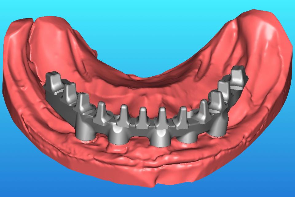Fig. 50: Design for a CAD/CAM titanium framework on 5 dental implants