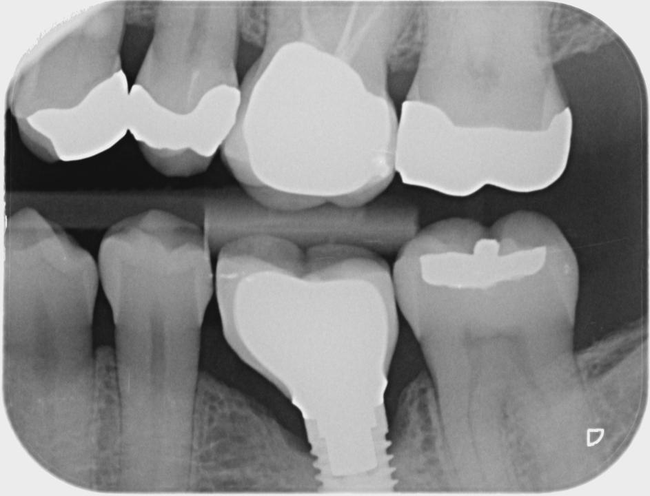 Fig. 5a: Pérdida ósea progresiva en el lecho del implante 36. La radiografía de aleta de mordida muestra los niveles óseos marginales aproximadamente en los hilos 1 - 2