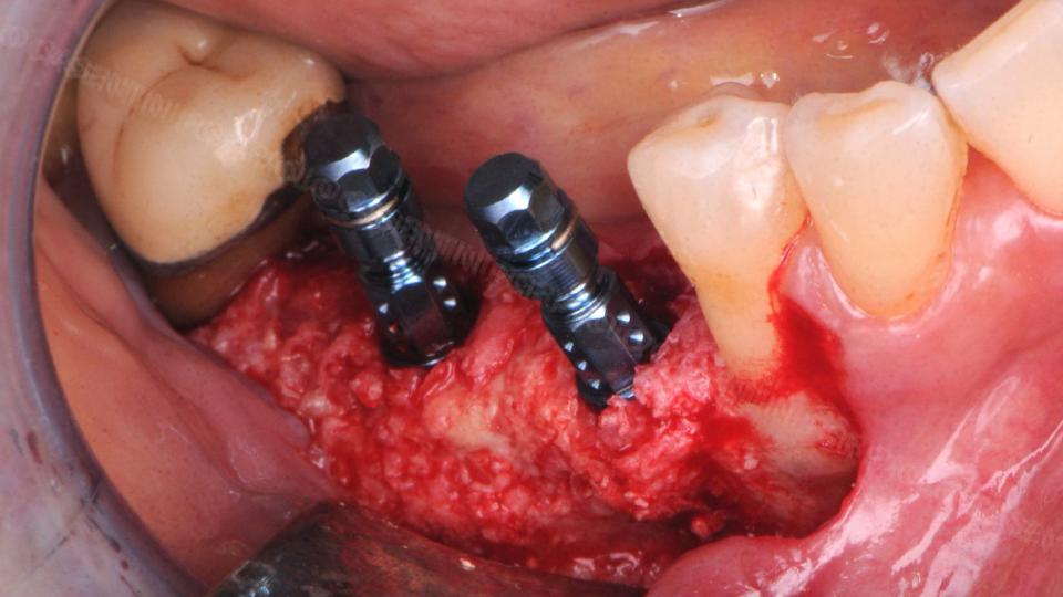 Fig. 19: Implant insertion procedures