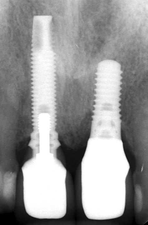 Fig. 5c: The corresponding peri-apical radiograph shows the presence of two implants replacing the missing teeth 11 and 21, featuring inconspicuous bony conditions