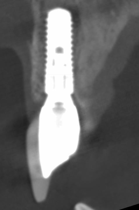 Fig. 5f: The CBCT shows a fully intact and thick facial bone wall after 10 years of function. The peak of the facial wall is roughly 1.5 mm coronally to the implant shoulder
