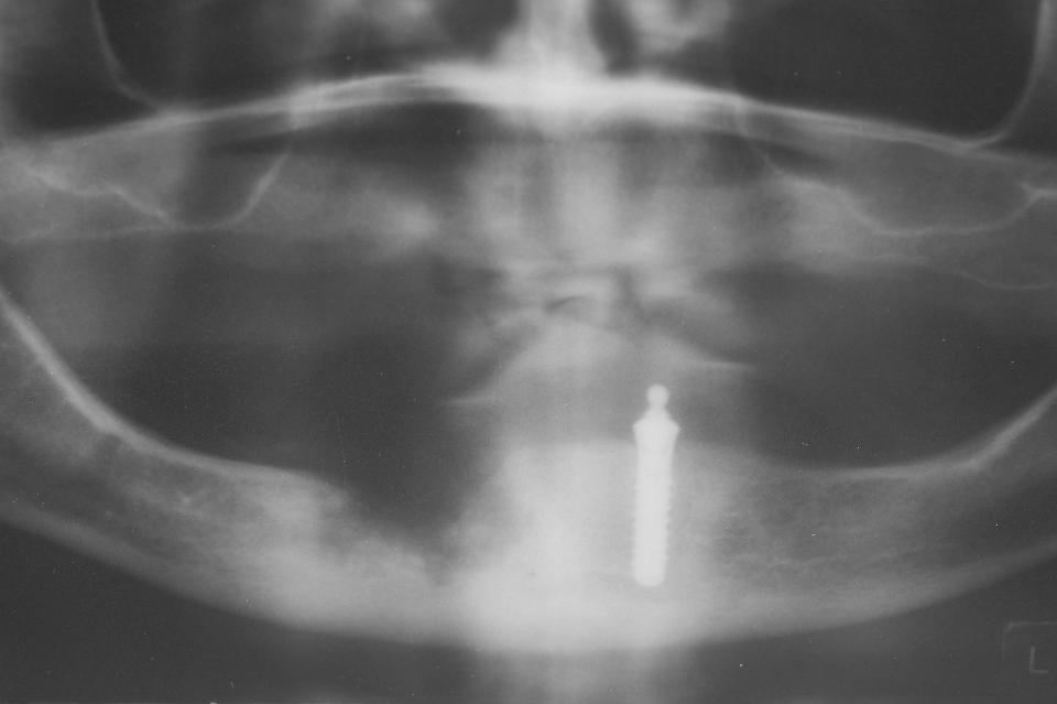 Fig. 13b: Imagem radiográfica mostra destruição severa da estrutura óssea após ressecção de osso necrótico com implante dentário