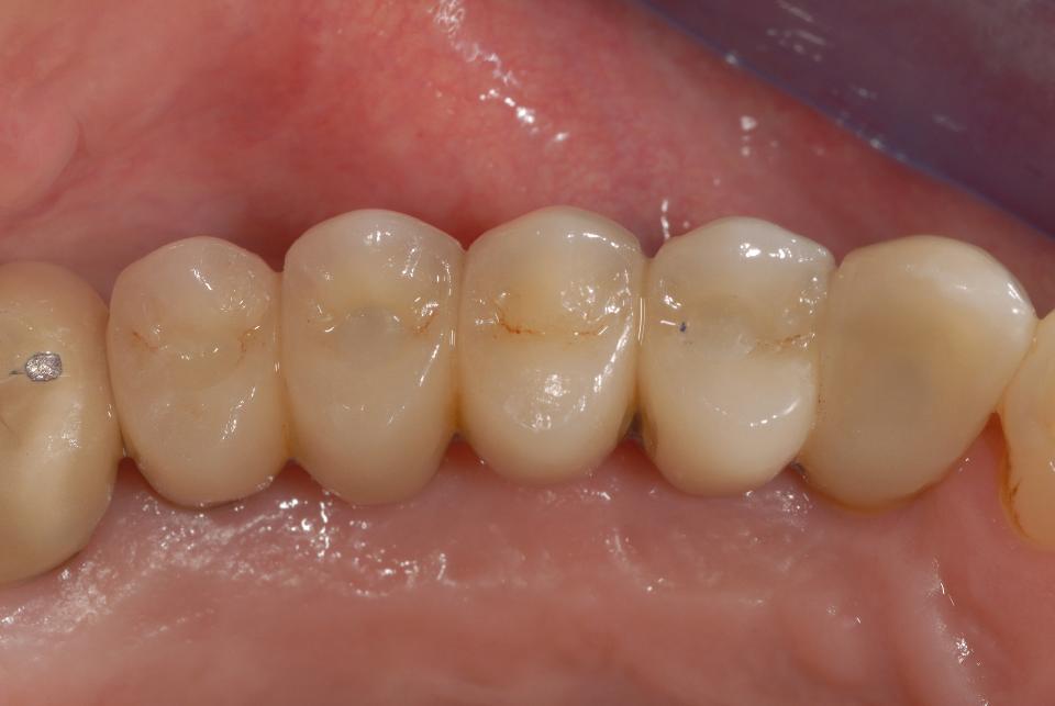 Fig. 11l: Occlusal view after insertion of the new 5-unit screw-retained metal-ceramic FDP