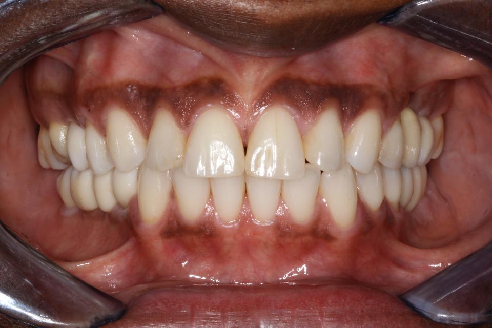 Fig. 7a: Prosthetic restoration with monolithic full-zirconia crowns