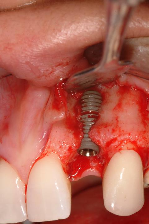 Fig. 3a: Cylindrical implant caused need for additional grafting. A similarly sized tapered implant was not available at the time of surgery. 10-year result shows that despite this macro-design-induced challenge, excellent esthetic results and tissue stability were achieved. a: surgical placement with significant apical protrusion of the cylindrical implant. b: 10-year clinical result showing stable tissue contours. C: 10-year radiograph showing stable proximal bone levels