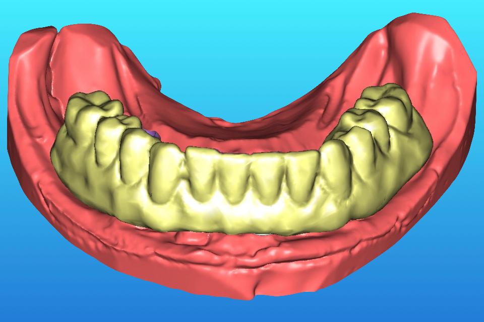 Fig. 49: When the clinician requires a clinical trial insertion, and/or the dental technician needs the articulated analog casts to re-position the manufactured framework or prosthesis for subsequent finishing process, a partial digital workflow should be used. This figure illustrates the digitalization of a milled cast, and diagnostic tooth arrangement after obtaining patient’s approval from clinical trial insertion