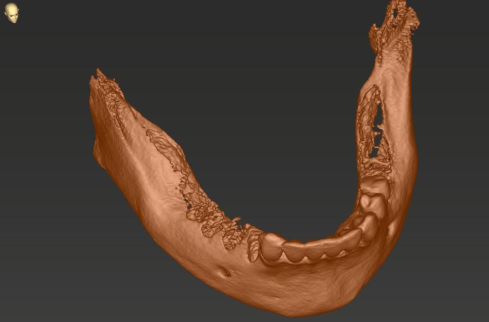 Fig 2a: CBCT scan
