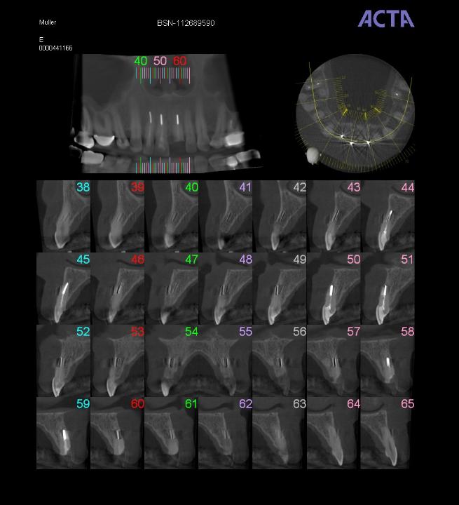 Fig. 11: CBCT image: Hopeless central incisor and thin buccal bone