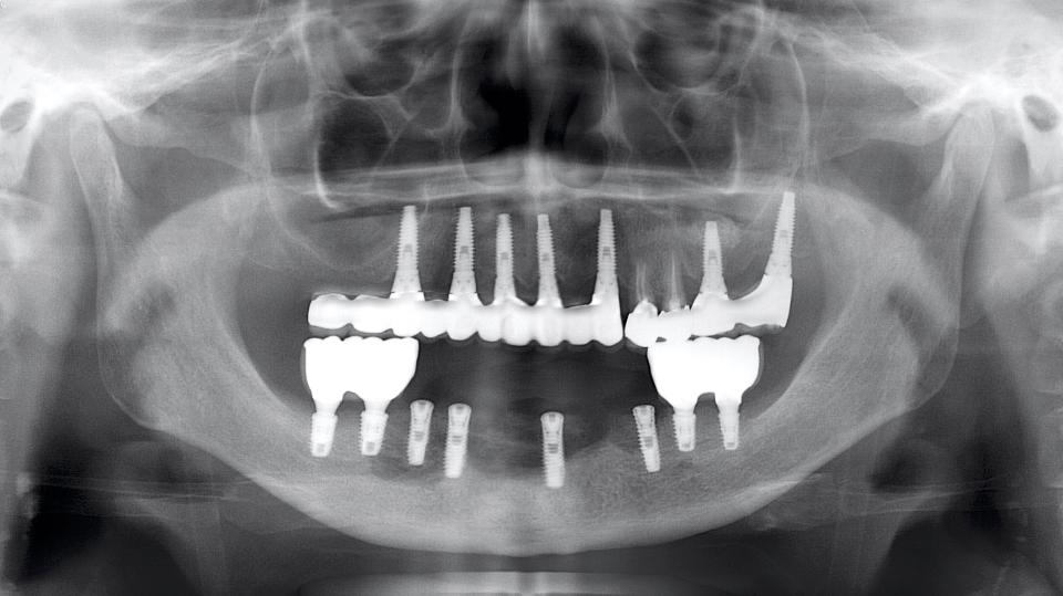 図14b: X線写真から、下顎の4本のボーンレベルインプラント（インターナル）周囲の骨構造が著しく破壊されていることがわかる
