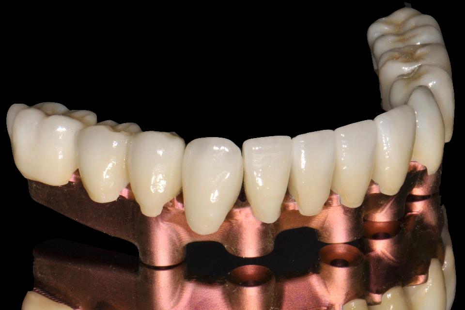 Fig. 52: CAD/CAM (milled) anodized titanium framework and zirconia crowns