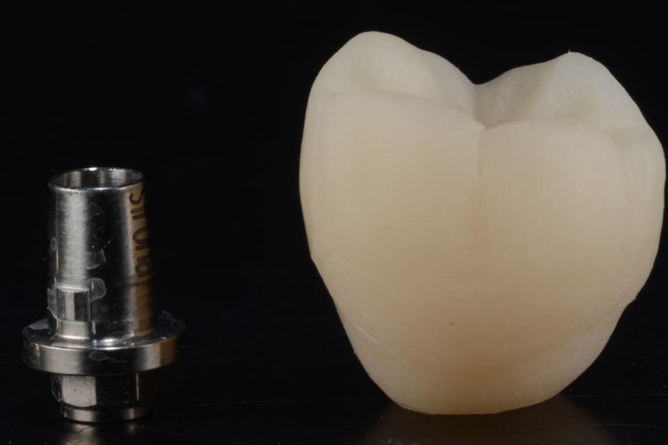 Fig. 10: Monolithic lithium disilicate crown and titanium abutment (Sirona TiBase; Sirona, Germany) for 36