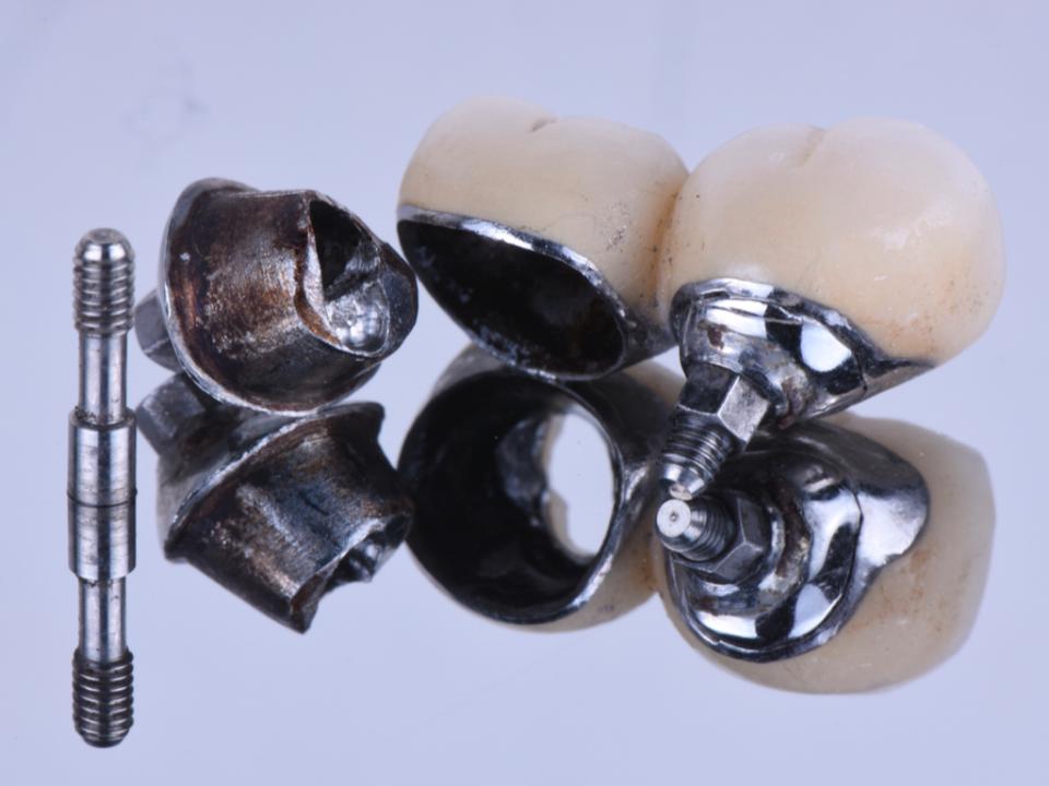 Fig. 5a: Complications techniques et biologiques des restaurations multi-unités implanto-portées (couronnes splintées) : décimentation et desserrage de la vis de l'implant distal des couronnes implanto-portées.