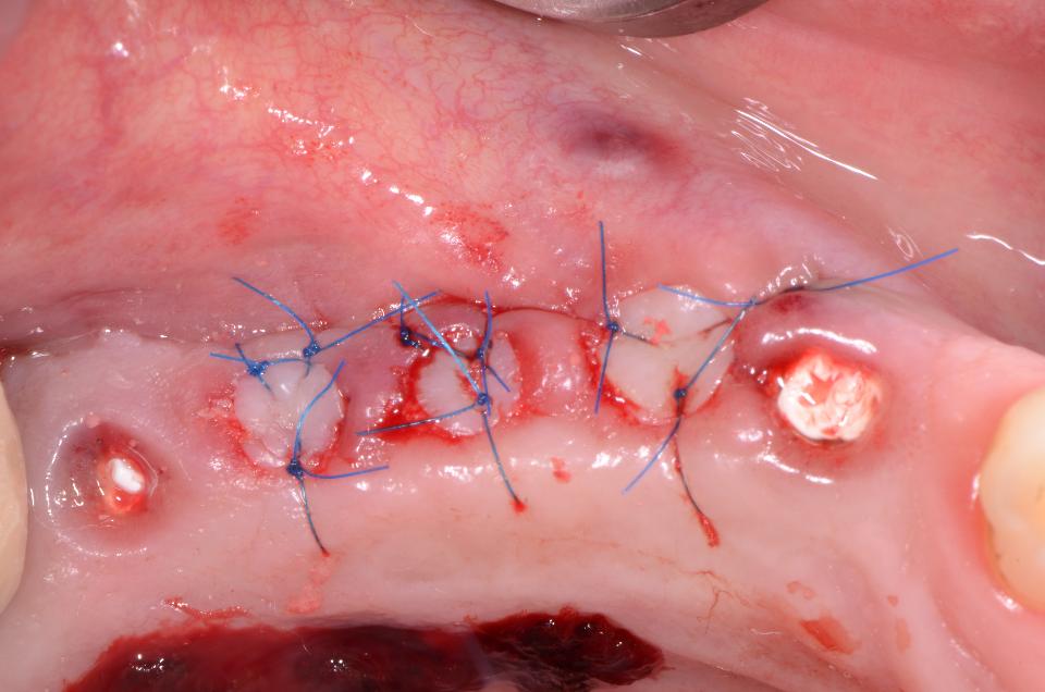 Fig. 11j: Full thickness mucosal grafts harvested from the palate with an appropriate punch device were used to completely close the implant removal sites. A limited number of interrupted sutures were applied to secure the grafts