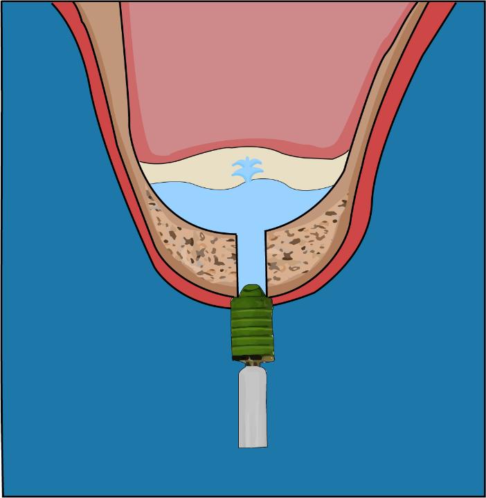 Fig. 10: Schematic diagram of MSFA via hydraulic pressure technique. After the use of osteotomes, saline is injected beneath the sinus membrane under hydraulic pressure with a suitably fitted syringe