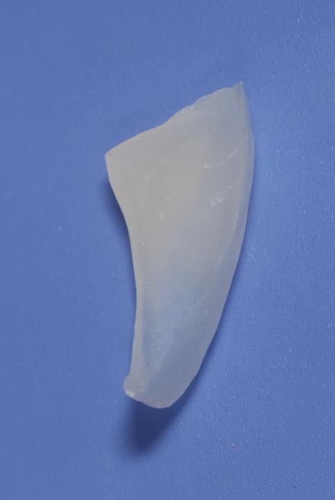 Fig. 3c: Without tooth preparation, a mesio-incisal partial veneer consisting of feldspar ceramics was produced on a refractory die