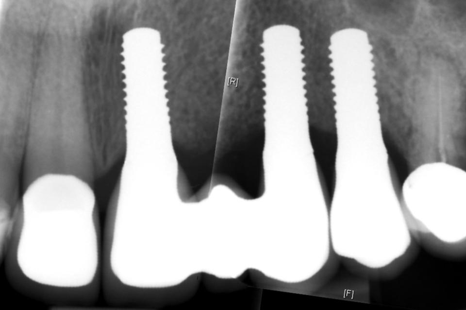 Abb. 5d: Die Röntgenaufnahme zeigt die perfekte Passung des Implantat-Prothesen-Übergangs (Fotografie: Stefan Roehling)