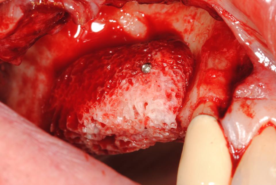 Fig. 6: Fixation of the block graft with a micro screw to the recipient site