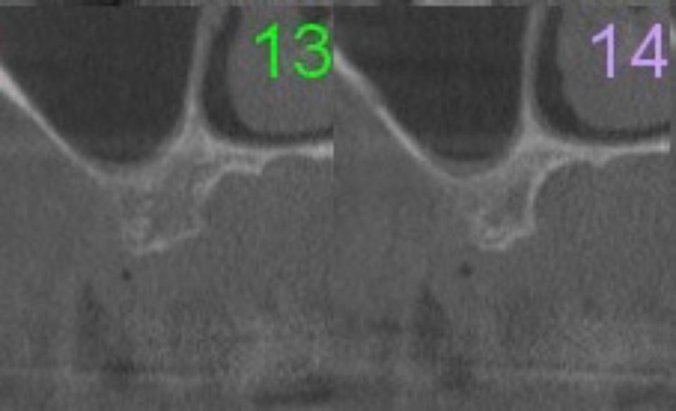 Fig 1b: Pre-op CBCT showing insufficient vertical bone dimension to place an implant