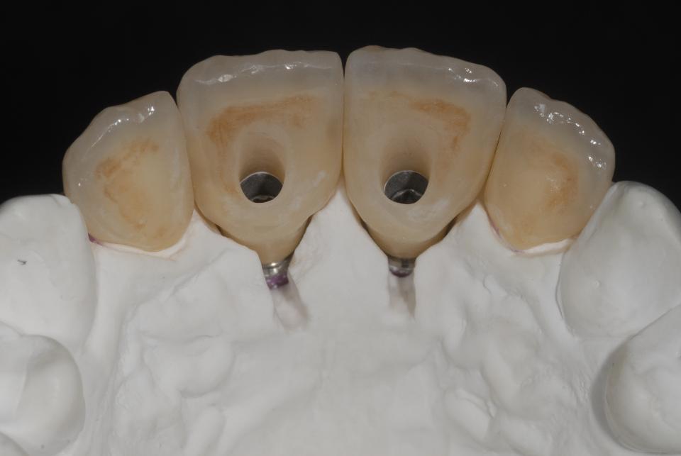 Fig. 6q: Facial (6p) and palatal (6q) close-up views of the finalized implant- and tooth-borne all-ceramic restorations. Note in particular the position of the facial transition line angles and the long interdental contact zones