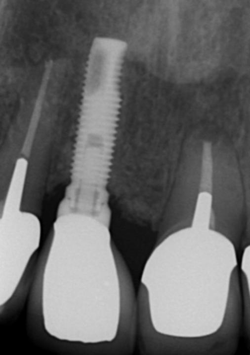 Fig. 6b: The corresponding radiographs reveal an axis problem of implant 11, endodontically treated and crowned teeth 12, 21 and 22 as well as a peri-apical chronic infection on root 21 