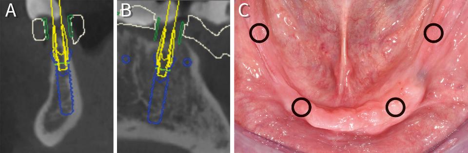 Fig. 16: Cross-sectional CBCT image of a canine area of an edentulous lower jaw with a thin crest (A). The planned implant type has to be placed deep subcrestally in spite of the reduced endosseous diameter (buccal view, B) in order for the microrough surface (green line) to be surrounded by a ≥ 1-mm thick bone. The peri-implant tissue surrounding such a deeply placed implant shoulder can remain biologically healthy only if the crest is accordingly reduced using an open flap procedure. Lower edentulous jaw with predominantly reduced keratinized mucosal width (C). Circles with a 4.8-mm diameter simulating the tissue to be removed for a flapless surgery are superimposed and show the invasion of the mobile mucosa