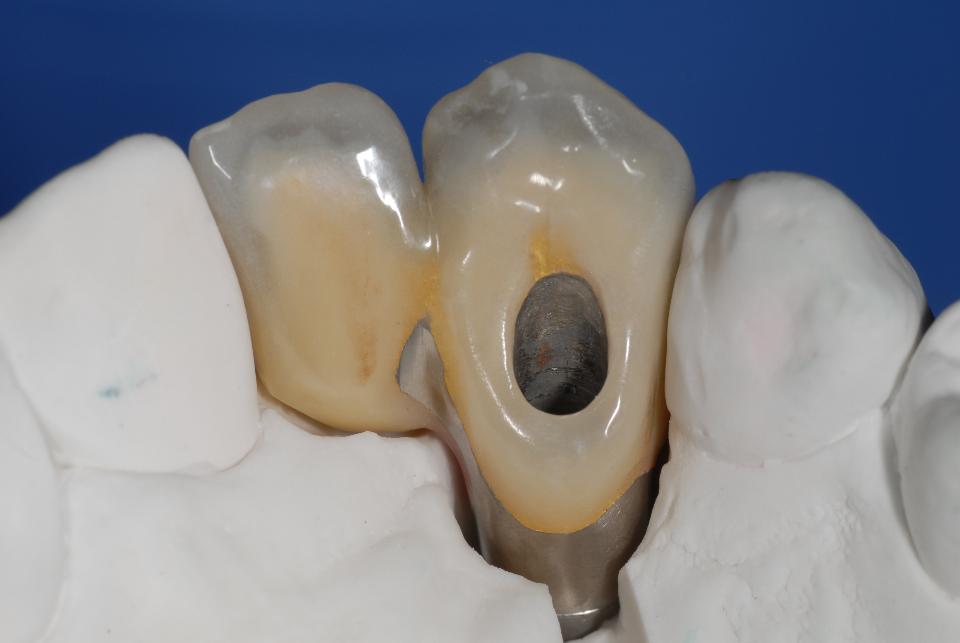 Fig. 4b: The close-up view of the master model shows the palatal aspect of the directly screw-retained ceramo-metal implant FDP. Note that the metal framework is extended to the lingual surface in order to give maximum strength to the connecting area between the implant crown and the cantilever unit