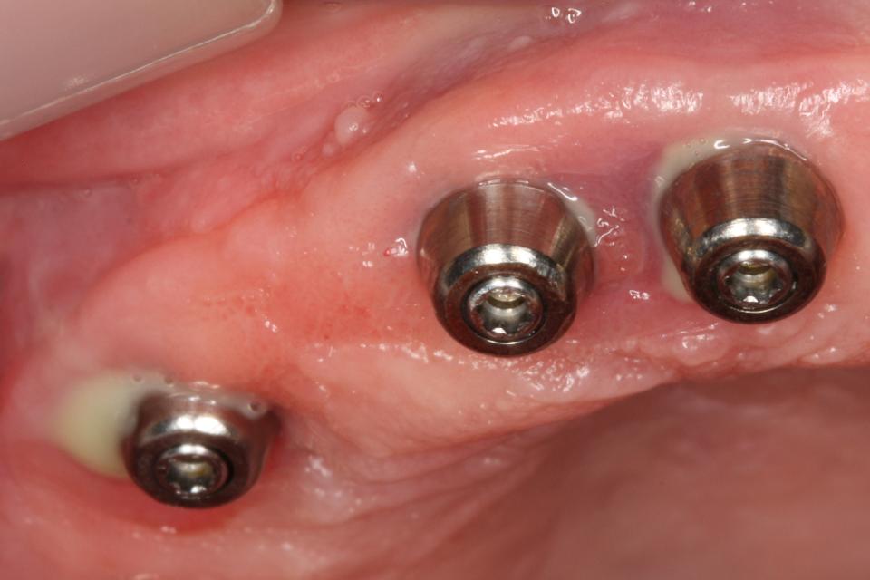 Fig. 3b: Peri-implantitis. Probing depths > 6 mm with suppuration on probing at all 3 implants. The prosthesis has been disconnected to enable peri-implant probing. A radiograph (not shown) confirmed progressive bone loss at all implants