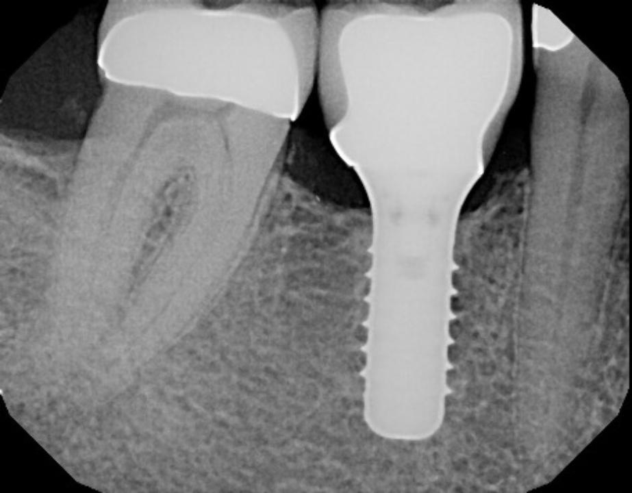 Fig. 20b: Radiograph showing excellent crestal bone maintenance