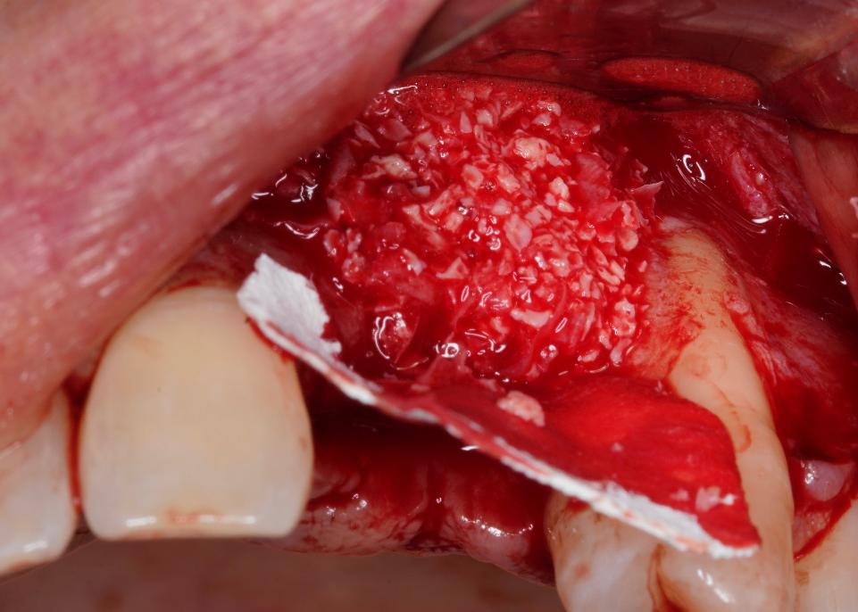 Fig. 3: Uso de matriz ósea bovina desproteinizada (DBBM) combinada con hueso autógeno extraído de un segundo lecho intraoral (rama mandibular) con una membrana de colágeno nativo fijada palatalmente con chinchetas de titanio para aumentar el lecho del implante