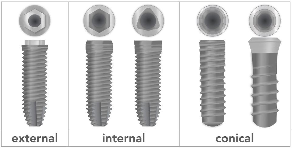 Fig. 10: Implant designs and connections