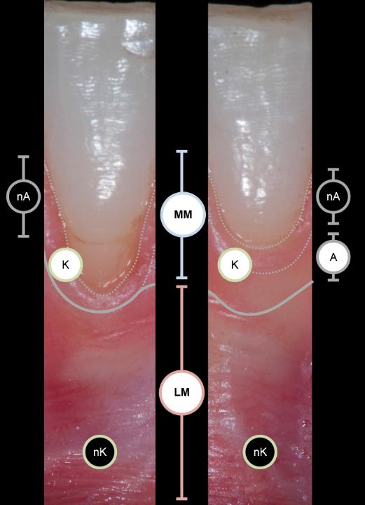 Fig. 3: Clinical situation with two neighboring lower incisors demonstrating two different conditions. Both sides with a keratinized (K) masticatory mucosa (MM) and a non-keratinized (nK) lining mucosa (LM). On the left is a situation with a small band of non-attached mucosa (nA), while on the right a situation with attached (A) and non-attached (nA) mucosa is shown