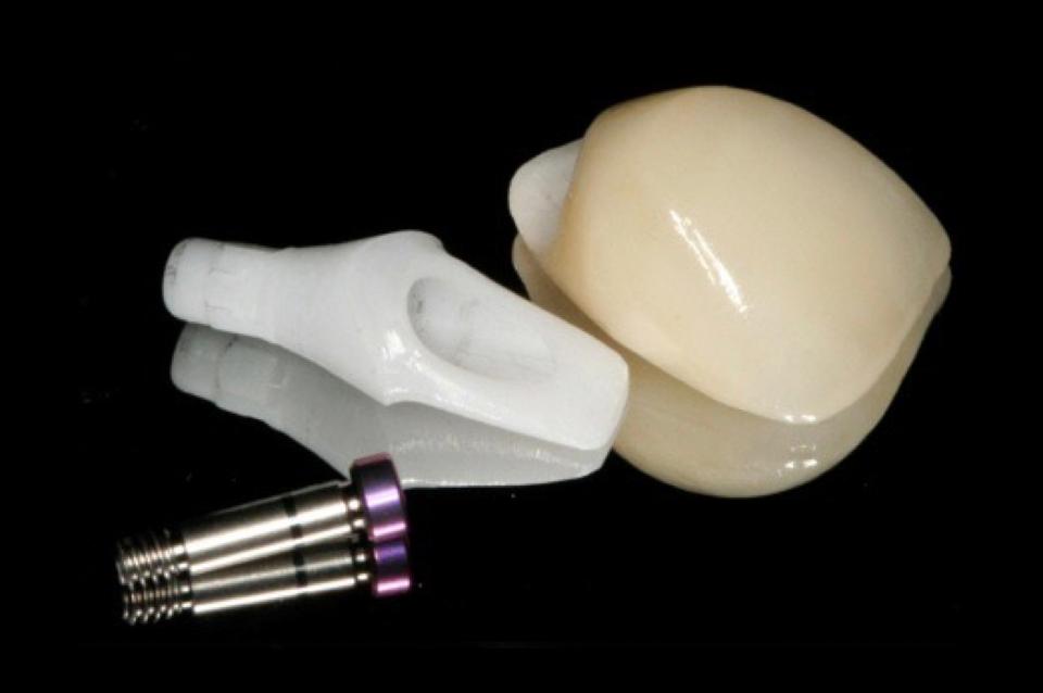 Fig. 8b: Image of screw with zirconia crown and zirconia abutment. Zirconia abutments require an internal metal screw although it is not exposed to any hard and soft tissue