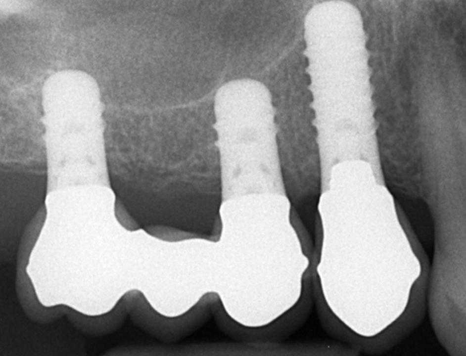 Fig. 3a: Distal extension situation in the right maxilla treated with two short 6-mm implants in a patient with no parafunctional habits. The short implants helped to avoid a SFE procedure. All three TL implants have been in function for 4 years and show excellent bone crest levels