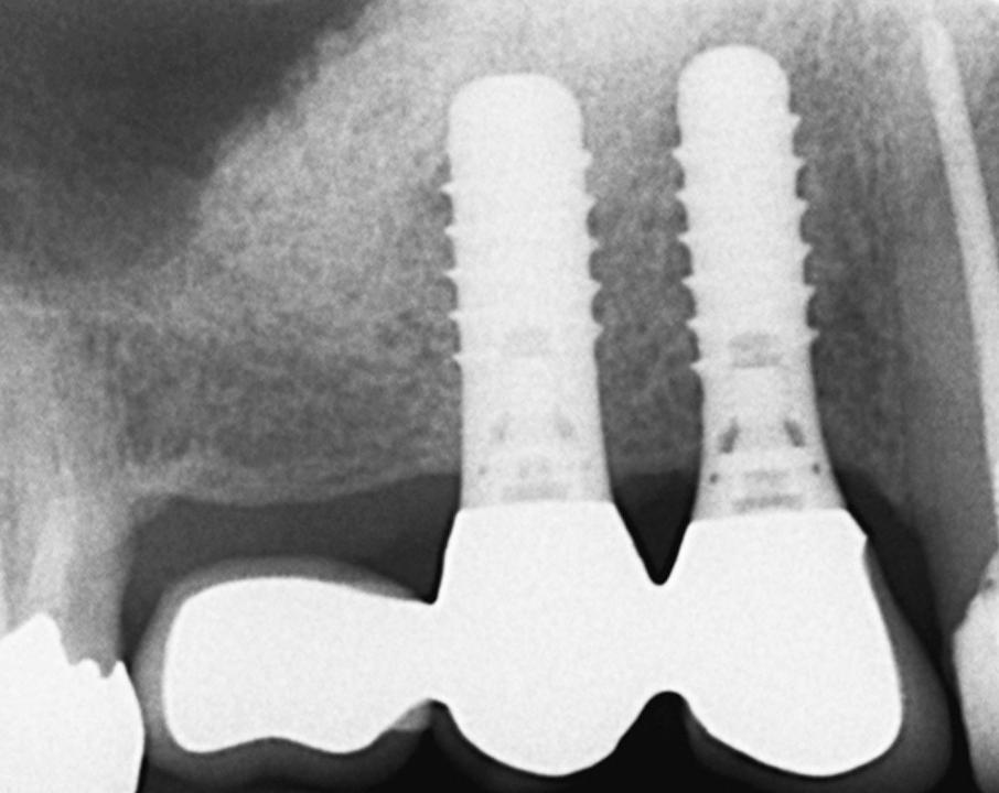 Fig. 6j: The 12-year follow-up radiograph confirms excellent stability in the crestal area at both implants