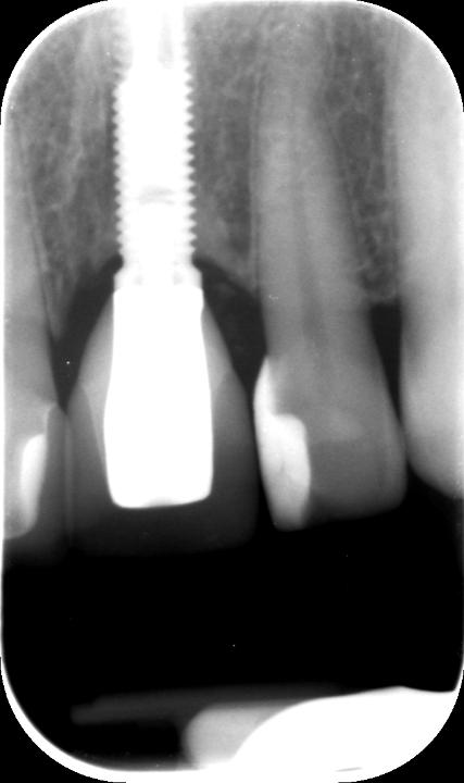 Fig. 5: Two-piece implant replacing tooth 21 with a matching implant-abutment diameter